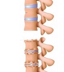 Étapes des rampes d'ostéochondrose du cou