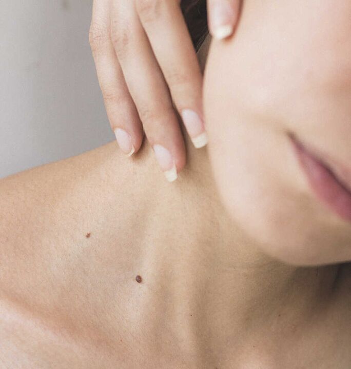 La raideur du cou est l'un des symptômes du stade initial de l'ostéochondrose de la colonne cervicale