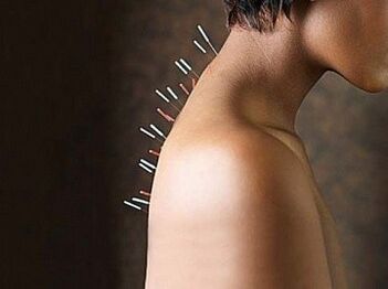 La réflexothérapie est une méthode efficace pour traiter l'ostéochondrose cervicale