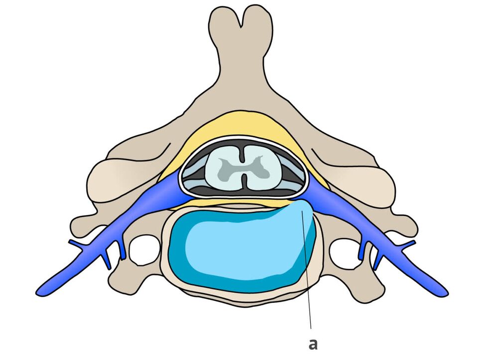 hernie intervertébrale avec ostéochondrose cervicale